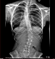 Radiografía escoliosis